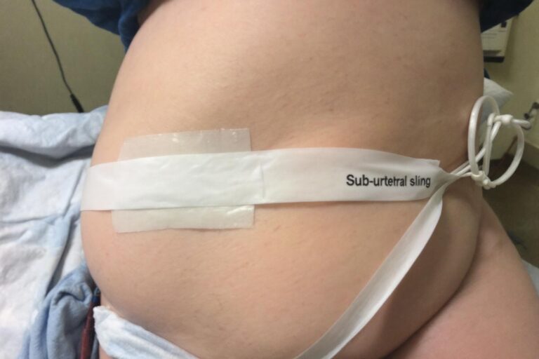 Bandelette sous-urétrale : traitement de l'incontinence urinaire