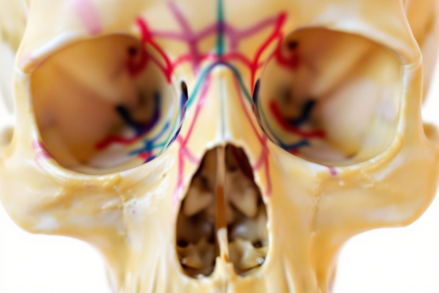 Hématome en lunettes : signe d'une fracture de la base du crâne